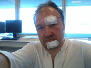 På hospitalet efter at jeg blevet syet