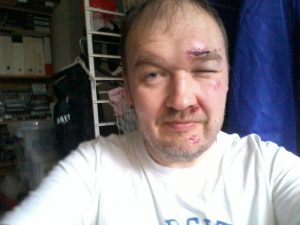 3 dage efter uheldet
